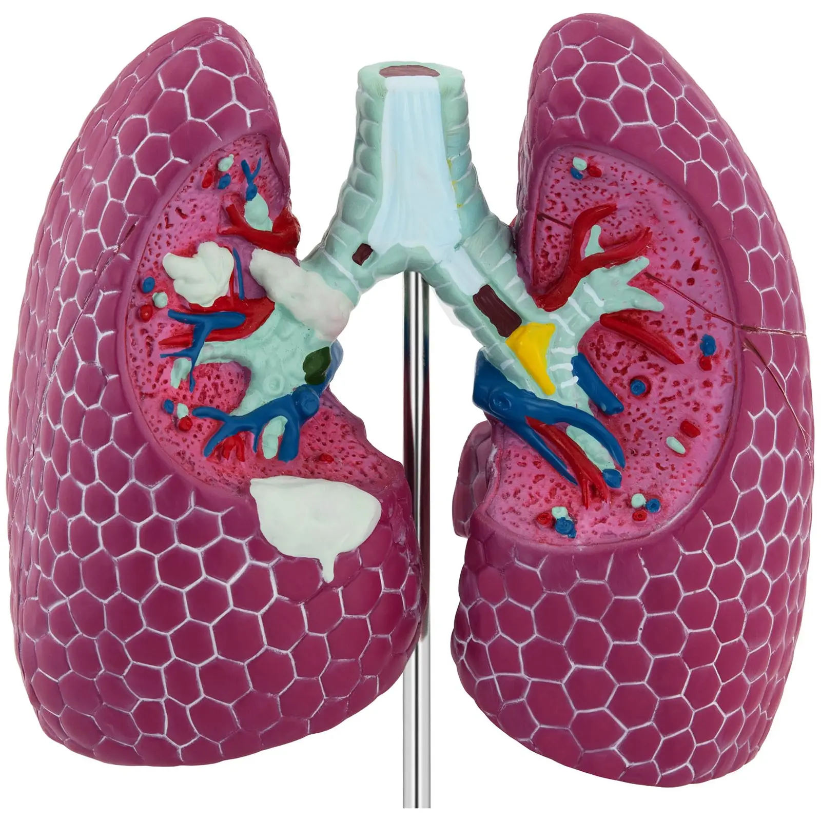 Lung Model - with pathologies | dev10.expondo.co.uk